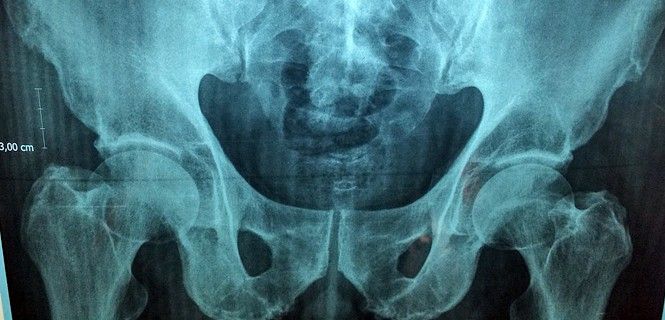Radiografía de la cadera de una persona. Prevenir la osteoporosis / Imagen: Manuel González Reyes - SINC
