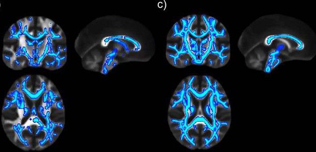 Modificaciones en la estructura cerebral detectadas en un paciente / Foto: Instituto Neurociencias Alicante