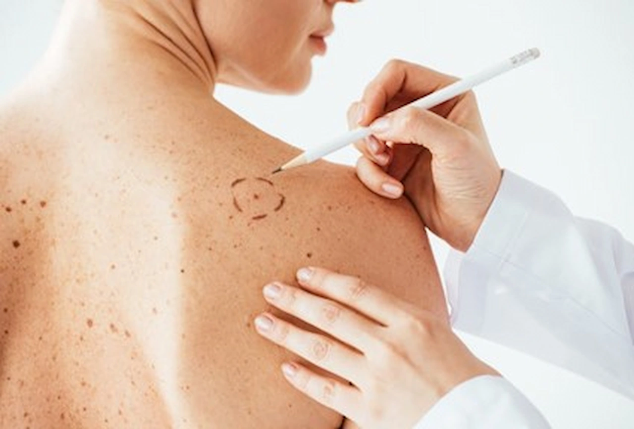 La vacuna contra el melanoma podría estar lista para el 2025 ¿Cómo funcionan? / Foto: The Conversation