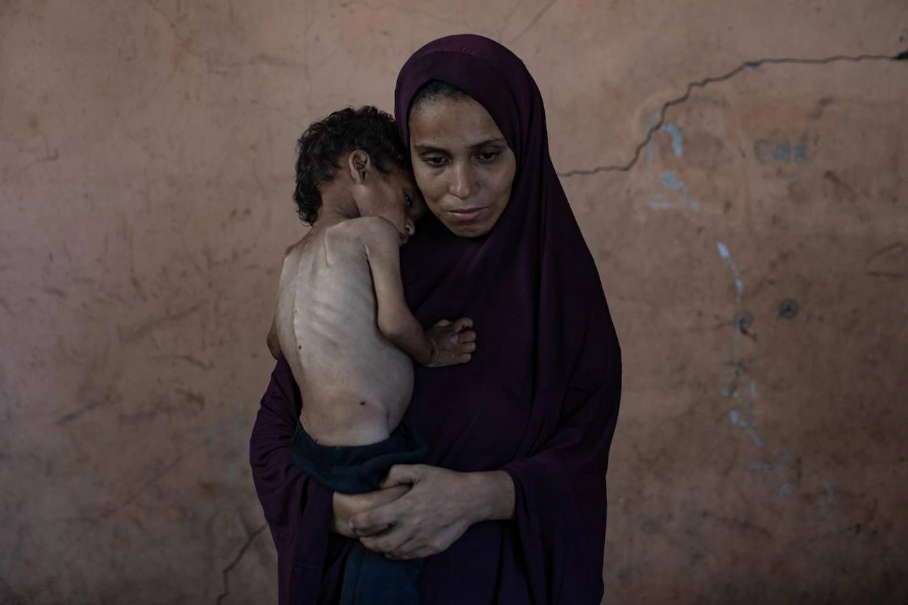 La hambruna que impone Israel a Palestina. Yazan Abu Foul, niño palestino de dos años, sufre desnutrición severa causada por el bloqueo impuesto por Israel / EFE-PA-Haitham Imad
