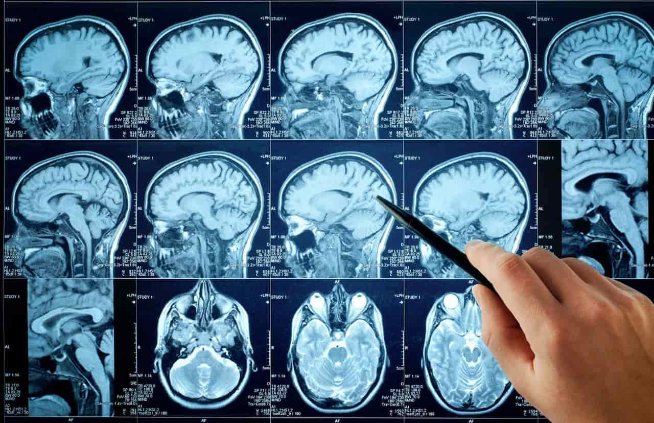 Resonancia magnética cerebral. Las señales cerebrales del olvido de recuerdos desagradables / Imagen: SINC