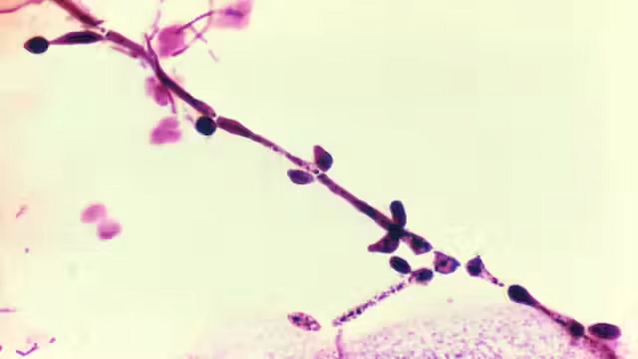‘Candida albicans’ obtenido en un frotis vaginal de una paciente con candidiasis vaginal / Imagen / Dr. Stuart Brown