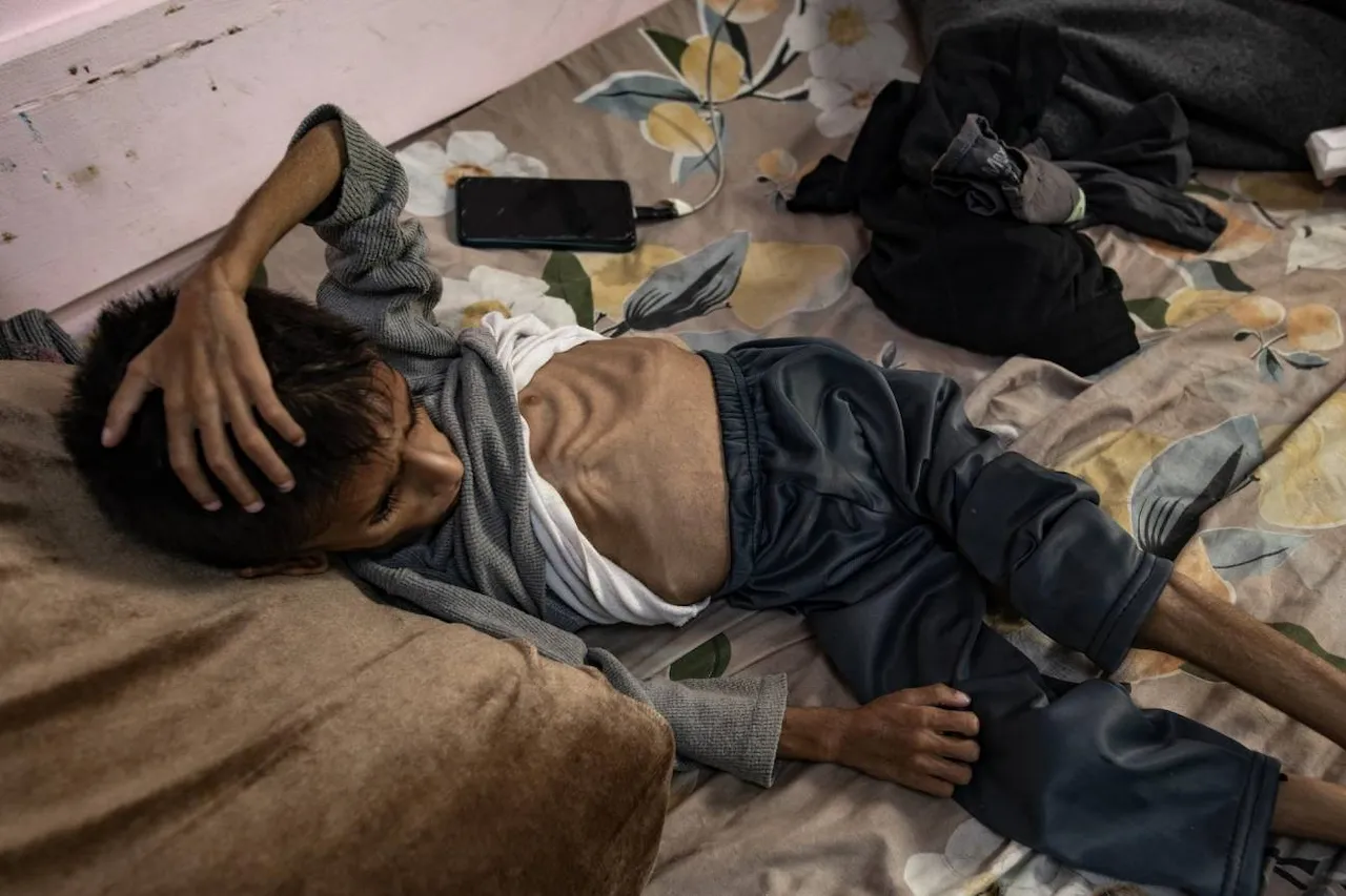 Mas de 54 000 niños y niñas en Gaza con desnutricion severa. El niño palestino de cinco años Osama al-Raqab, quien sufre de desnutrición severa en el Hospital Nasser, sur de la Franja de Gaza / Foto: EFE-EPA-Haitham Imad