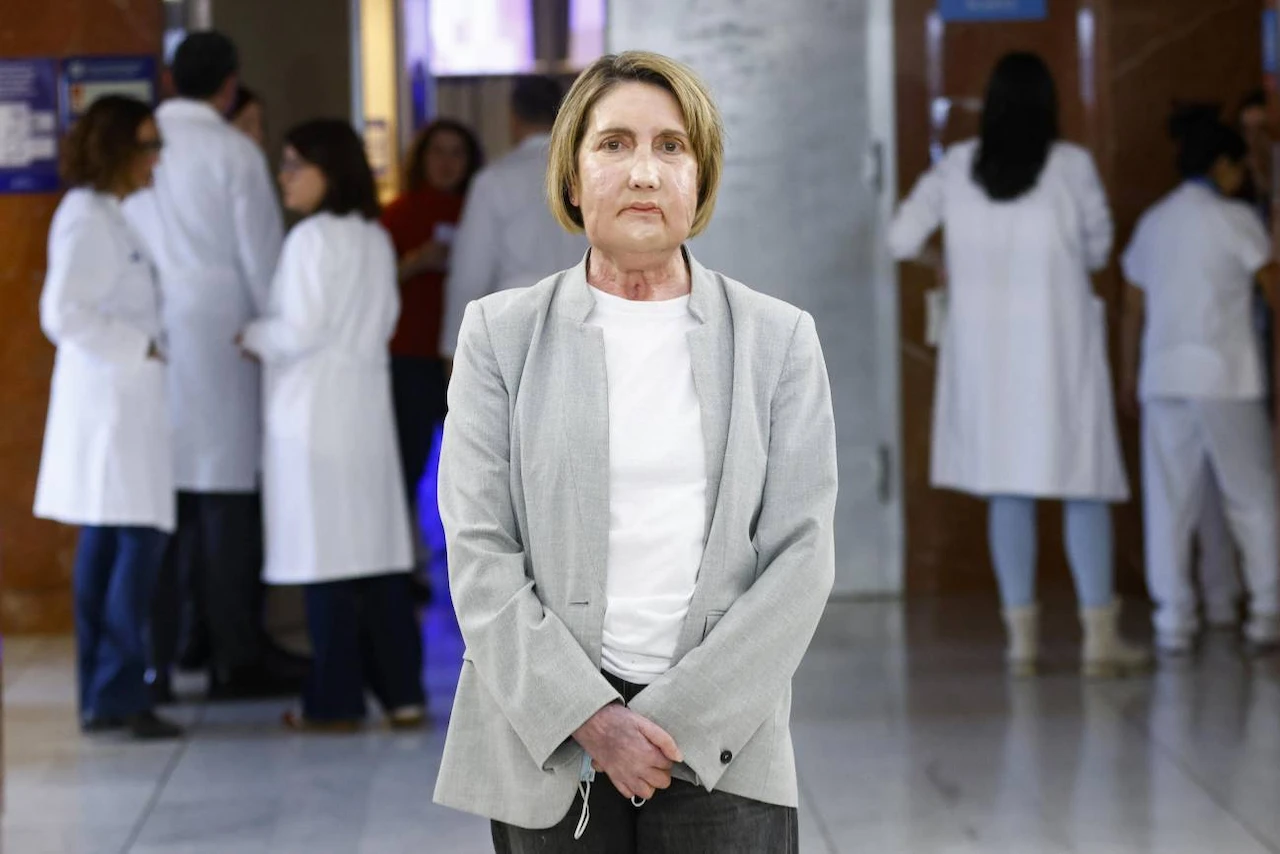 Carmen, la paciente que recibió el trasplante de cara / Foto: EFE-Quique García