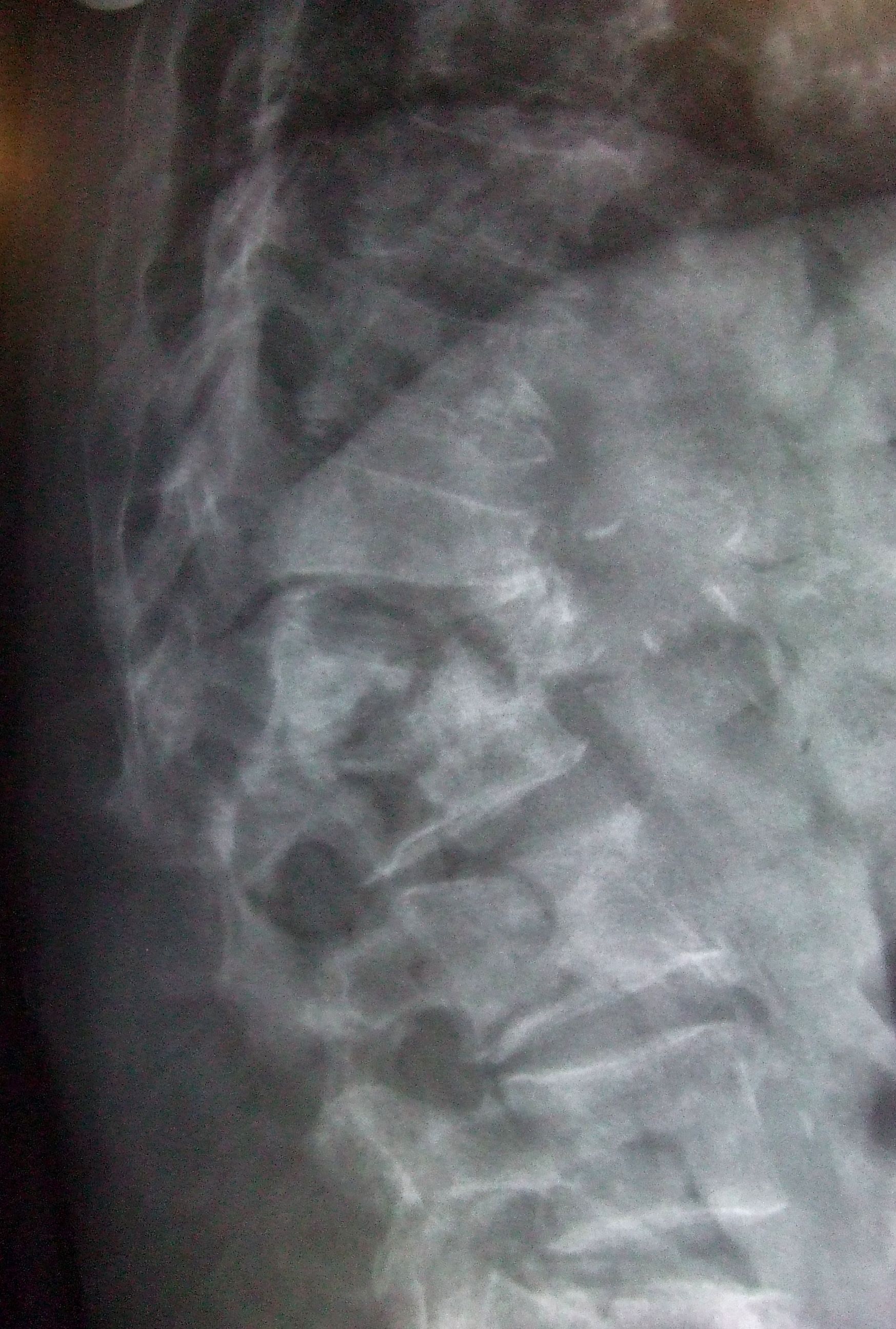 Radiografía de fracturas vertebrales causadas por osteoporosis, que se suele confundir con la HPP / Foto: Wikipedia