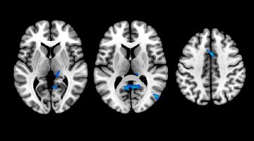 Las personas con insomnio presentan un menor volumen en algunas regiones cerebrales / Foto: Fundació Pasqual Maragall