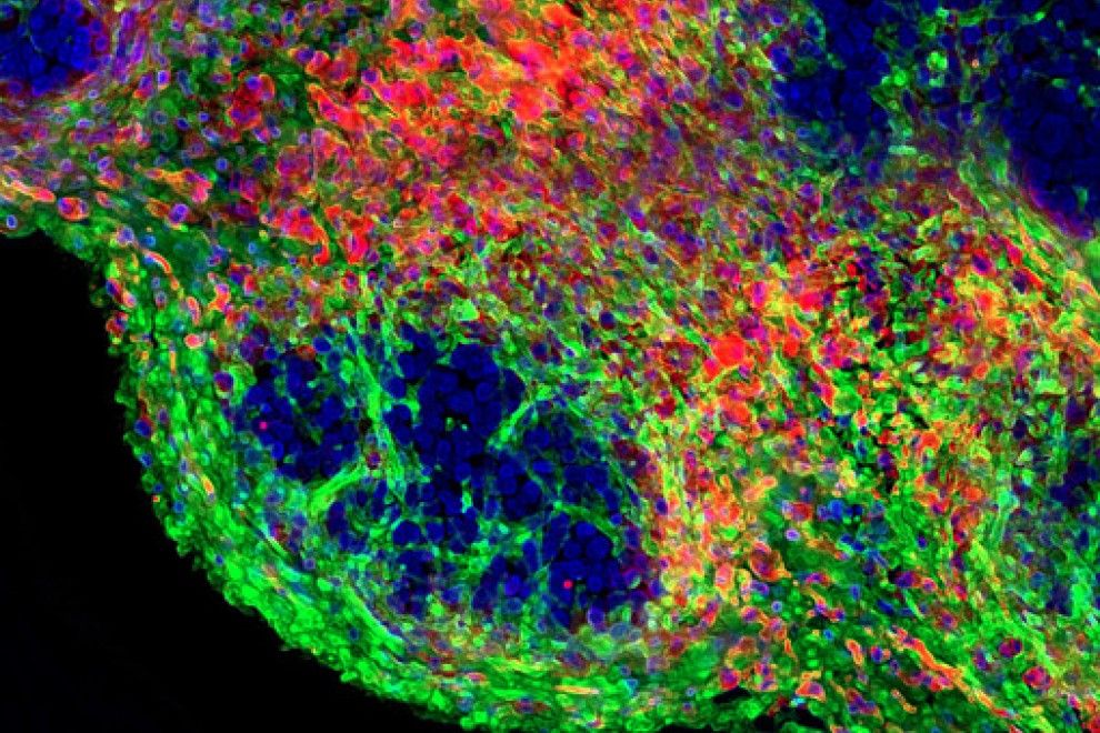 Imagen por inmunofluorescencia que muestra células tumorales (azul), rodeadas por una matriz de colágeno (verde) y fibroblastos (magenta) / Foto: Jennifer Harris