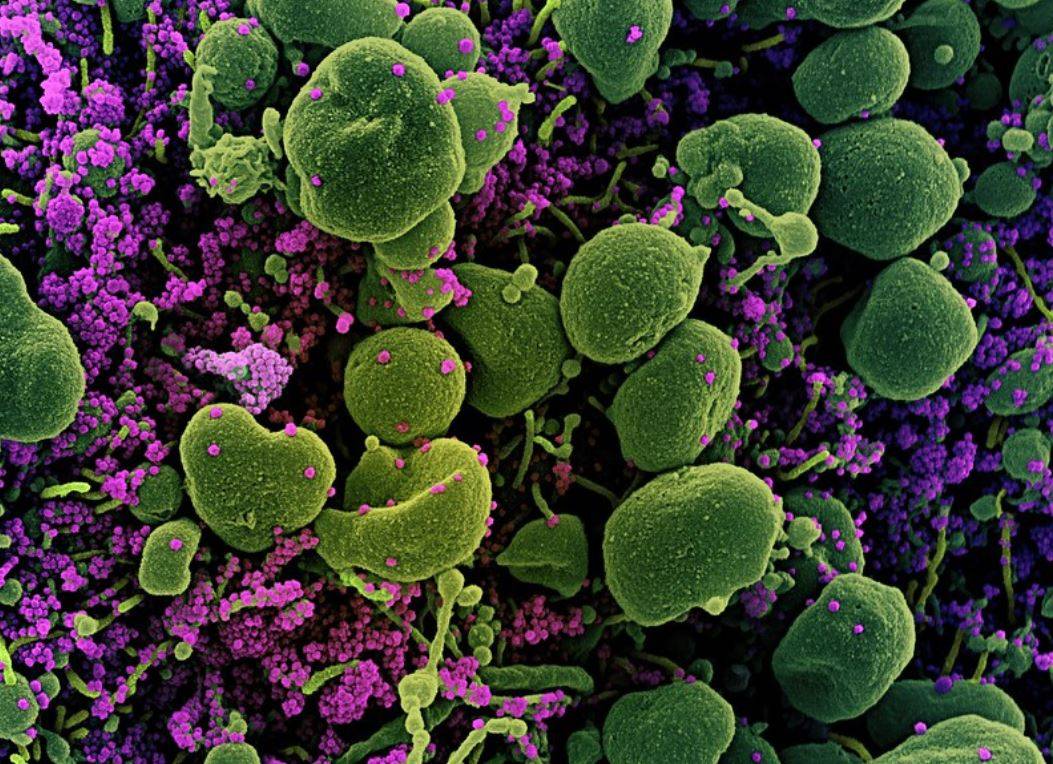 Micrografía electrónica de barrido coloreada de una célula apoptótica (verde) muy infectada con partículas del virus SARS-CoV-2 (púrpura), aislada de una muestra de paciente  /  Sinc